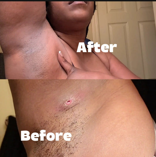 DIY Healing Oil for Flare Care: A Potent and Personal Recipe
